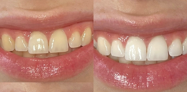 Teeth whitening before and after results at The Whitening Lab 3