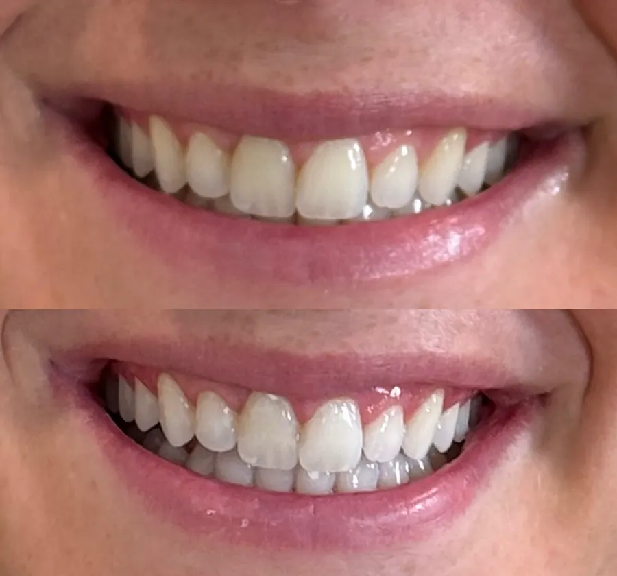 Before and after teeth whitening result 4 from a client at The Whitening Lab