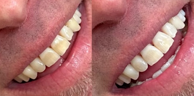 Teeth whitening before and after results at The Whitening Lab 11