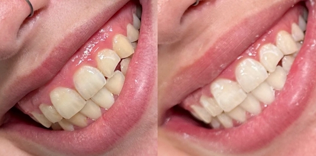 Teeth whitening before and after results at The Whitening Lab 7