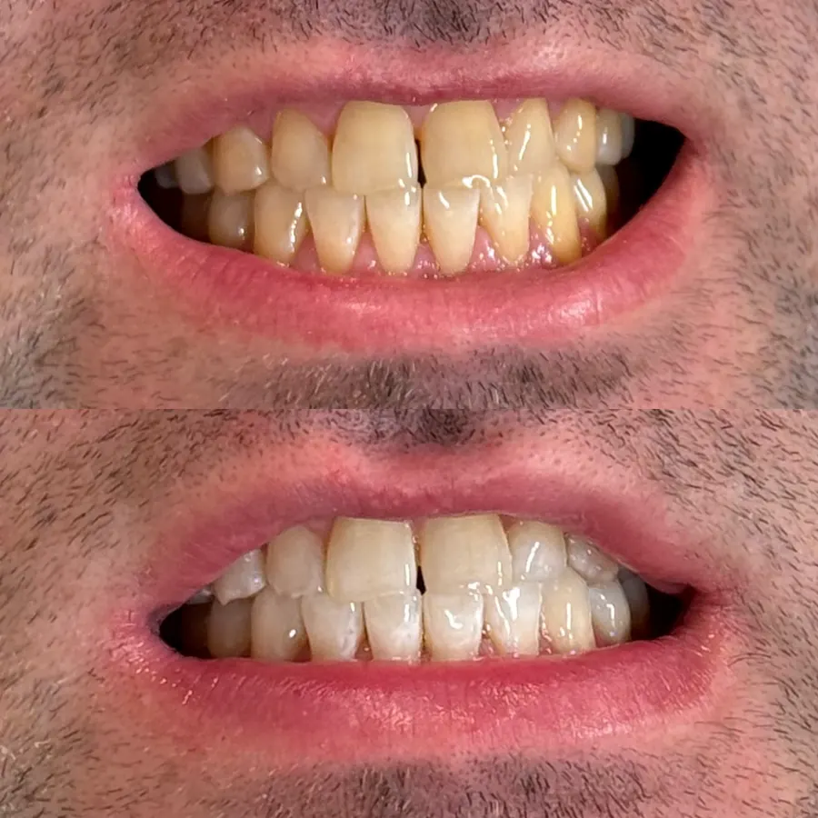 Before and after teeth whitening result 3 from a client at The Whitening Lab