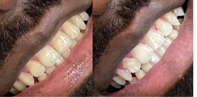 Teeth whitening before and after results at The Whitening Lab 2