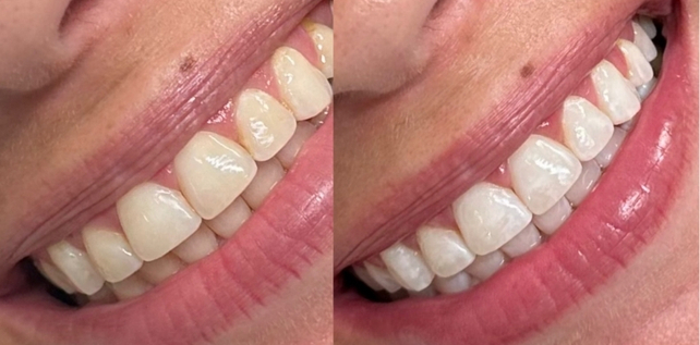 Teeth whitening before and after results at The Whitening Lab 5
