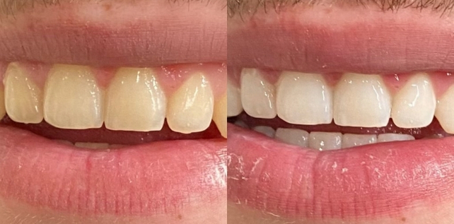 Teeth whitening before and after results at The Whitening Lab 6