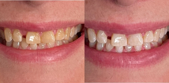 Teeth whitening before and after results at The Whitening Lab 8