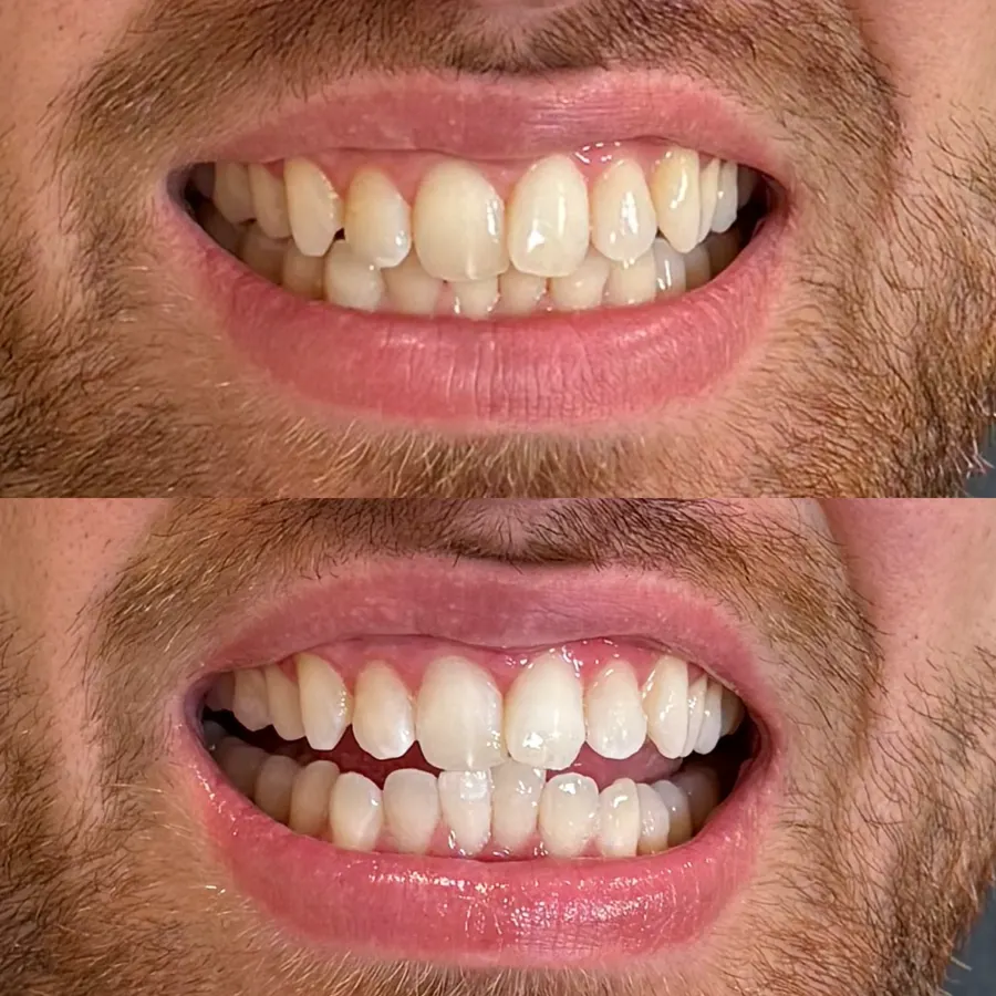 Before and after teeth whitening result 2 from a client at The Whitening Lab