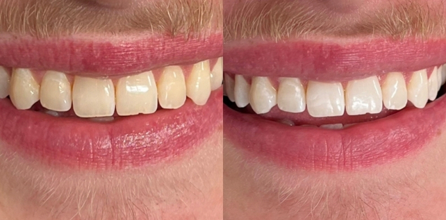 Teeth whitening before and after results at The Whitening Lab 4