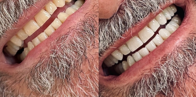 Teeth whitening before and after results at The Whitening Lab 12