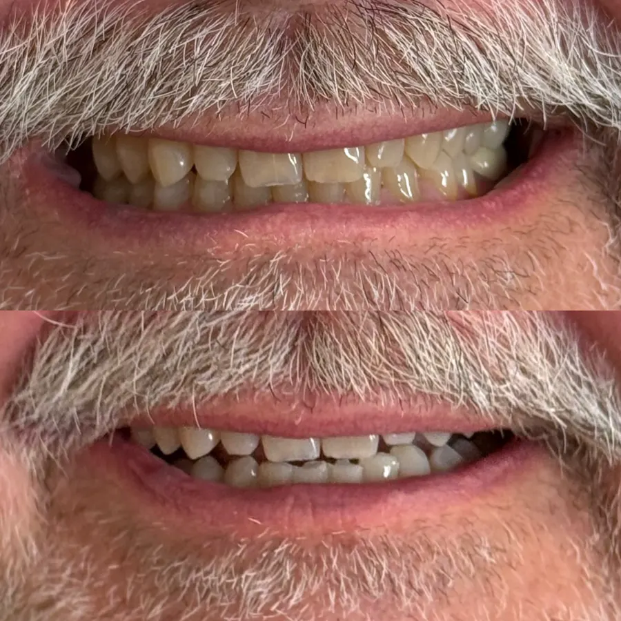 Before and after teeth whitening result 5 from a client at The Whitening Lab