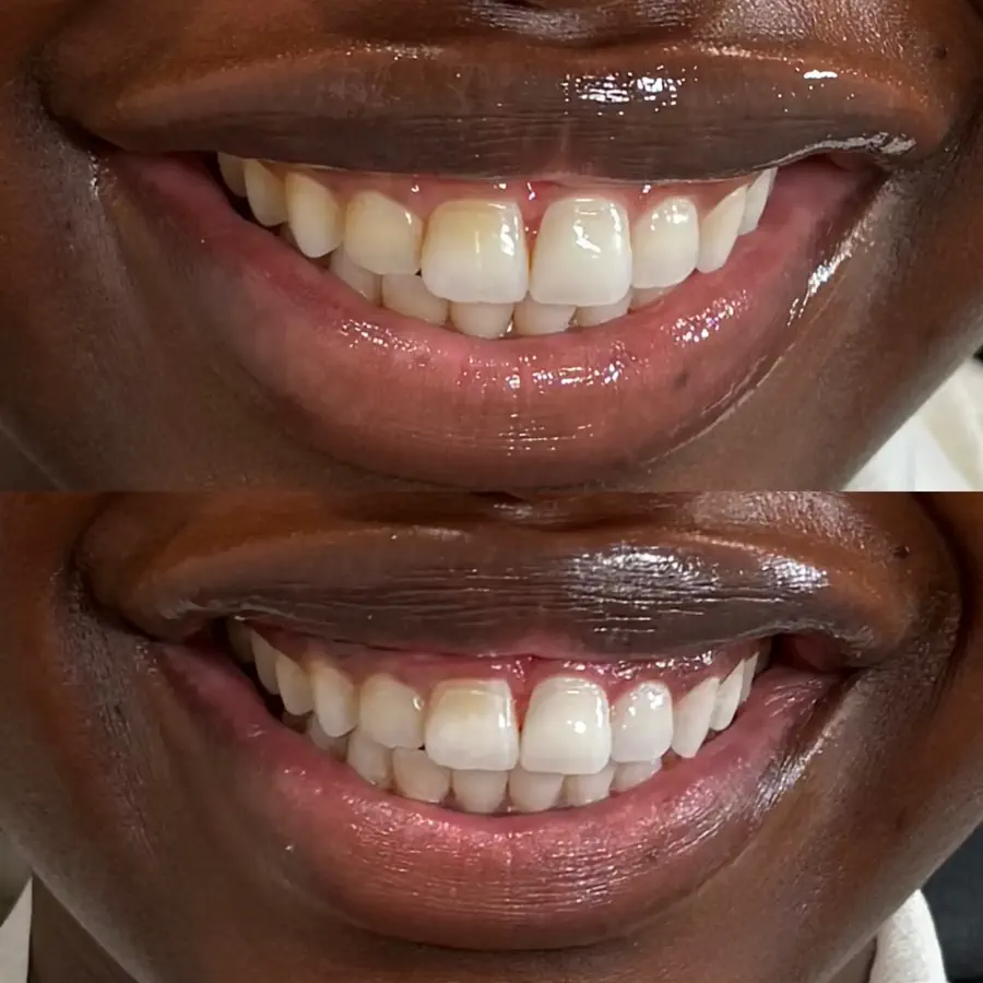 Before and after teeth whitening result 6 from a client at The Whitening Lab