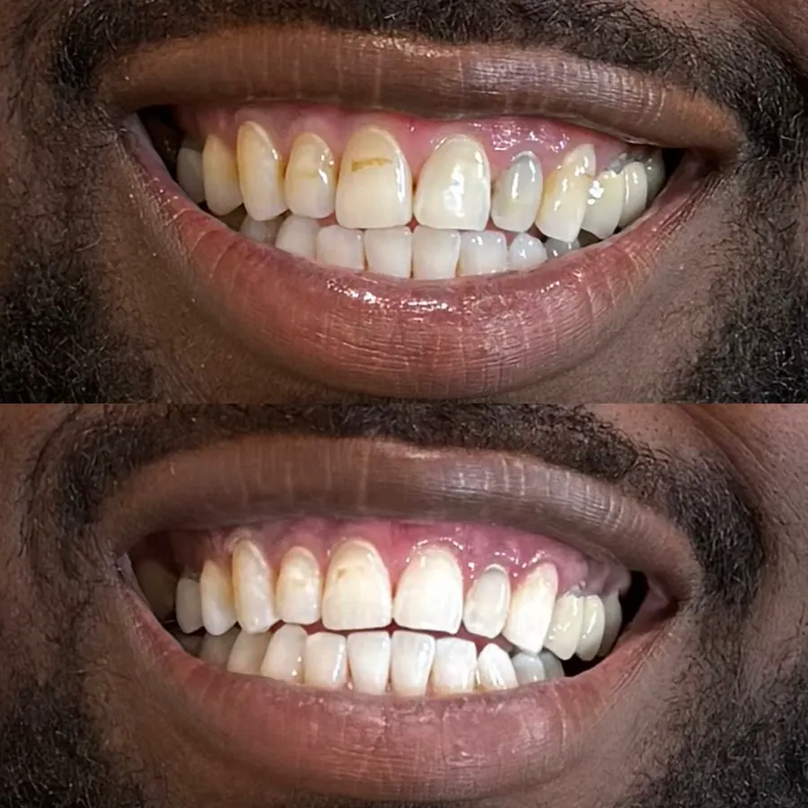 Before and after teeth whitening result 1 from a client at The Whitening Lab