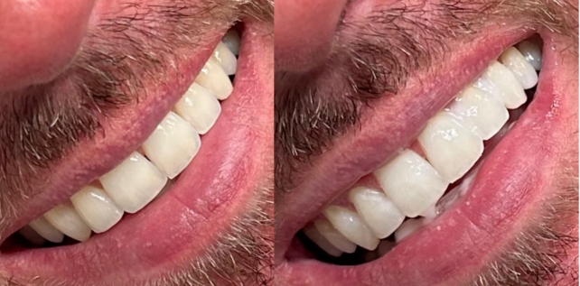 Teeth whitening before and after results at The Whitening Lab 1