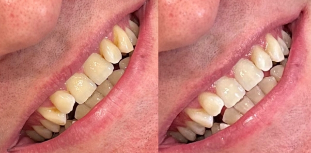 Teeth whitening before and after results at The Whitening Lab 9