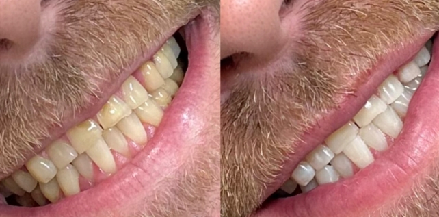 Teeth whitening before and after results at The Whitening Lab 10