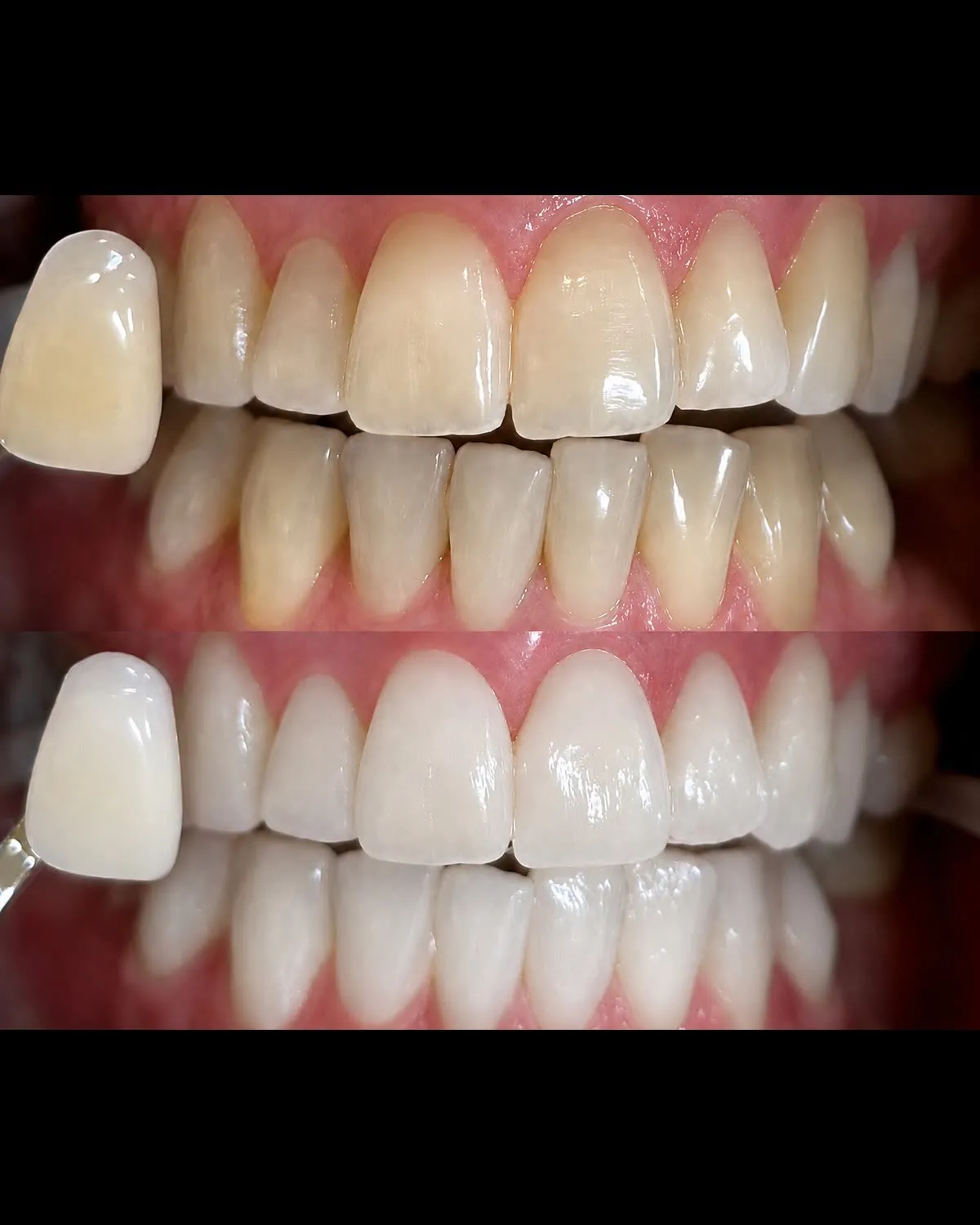 Patient 802 after whitening