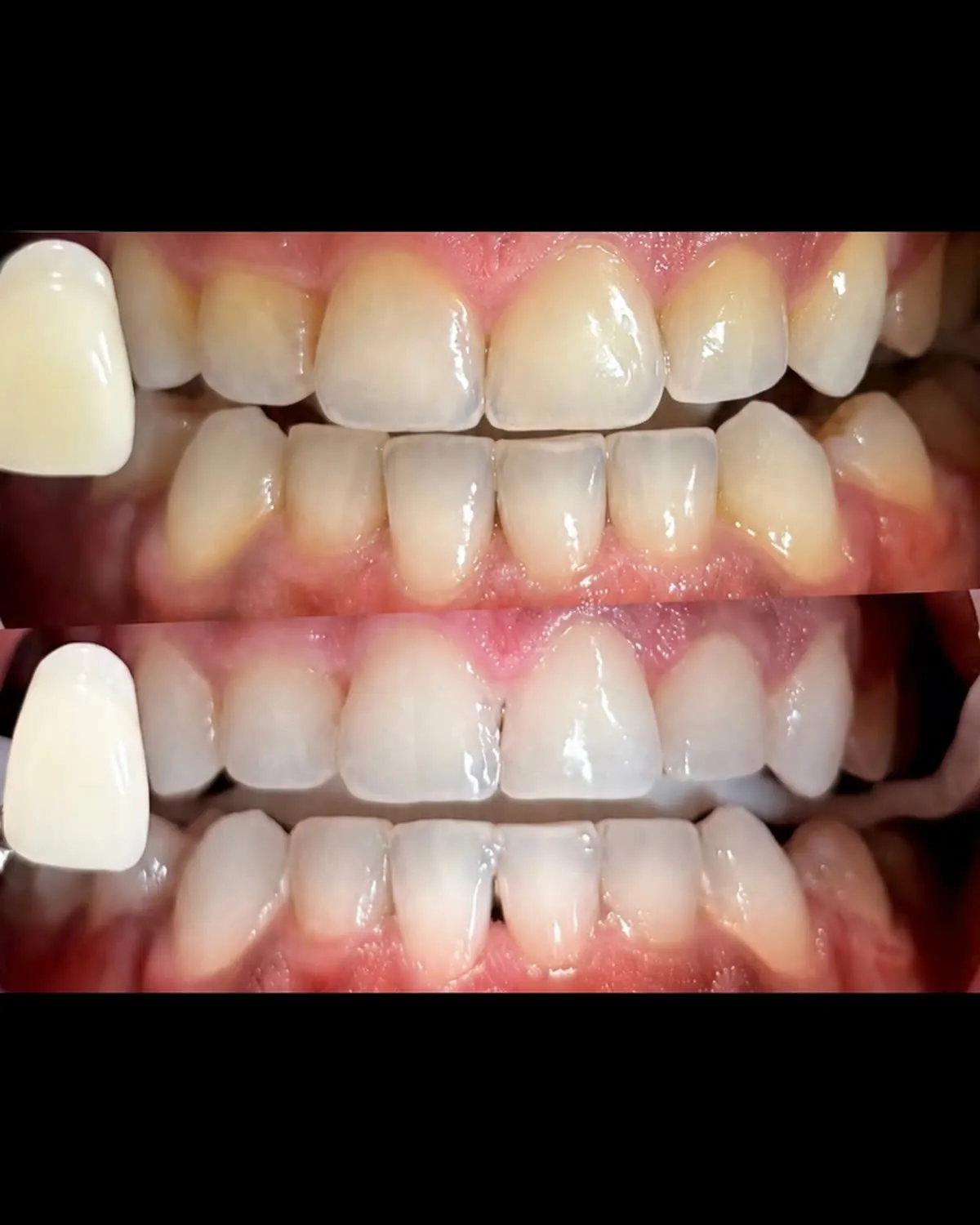 Patient 611 after whitening