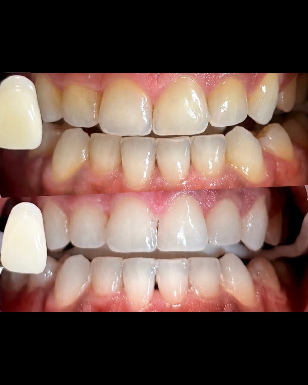 Patient 611 after whitening