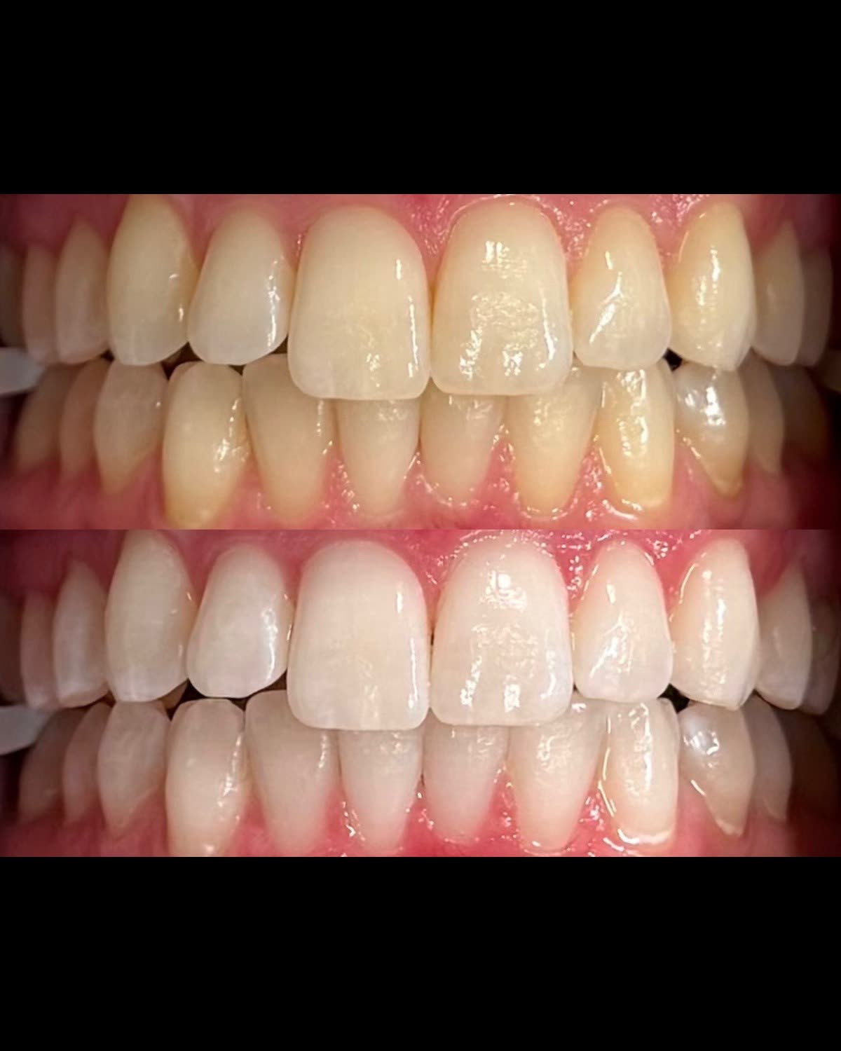 Patient 904 after whitening