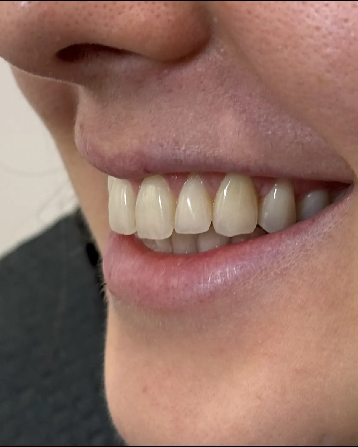 Patient 802 before whitening