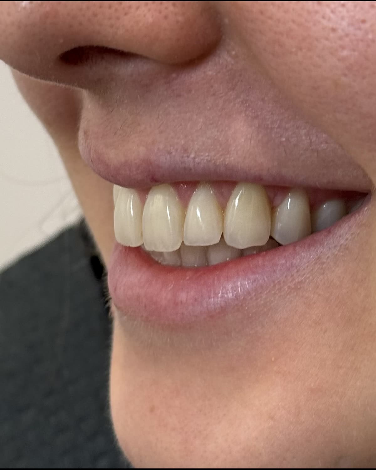 Patient 802 before whitening