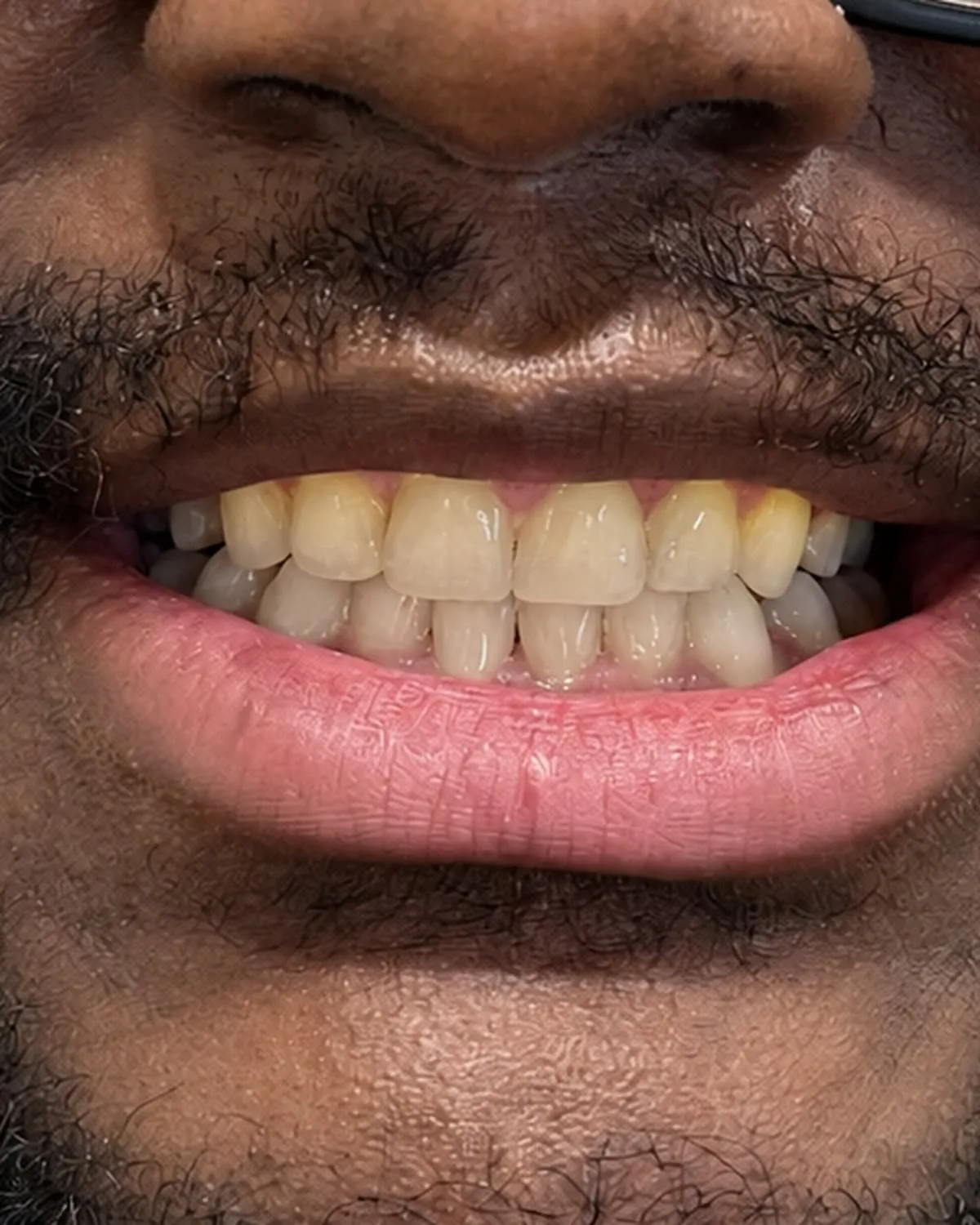 Patient 611 before whitening
