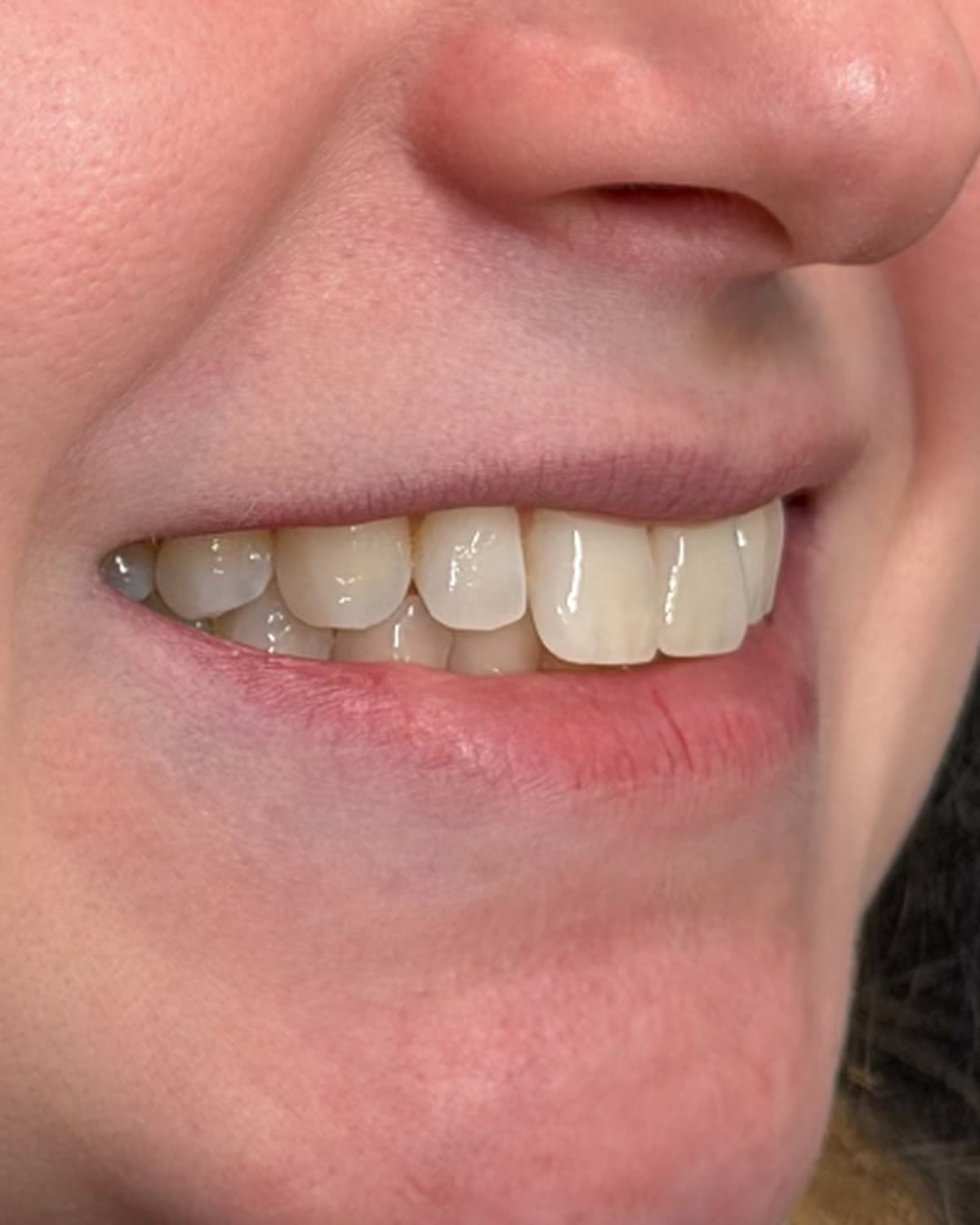 Patient 904 before whitening